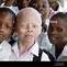 Image result for Child Boy Albino