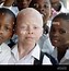 Image result for Albino Child