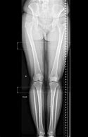 Image result for X-ray of Leg with Metal Plates