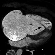 Image result for Interatrial Septum Lipomatous Hypertrophy Echo