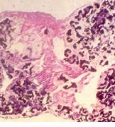 Image result for Actinomycetoma