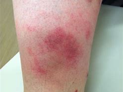 Image result for 10 Common Skin Rashes On Legs