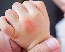 Image result for Baby Eczema Hands