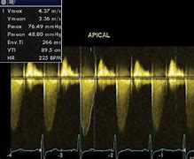 Image result for Aortic Stenosis Doppler