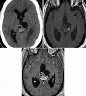 Image result for Teratoma Brain Tumor