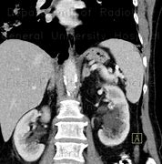 Image result for Adrenal Gland Adenoma