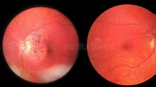 Image result for Damaged Retina