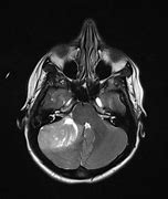 Image result for Shh Pathway Medulloblastoma