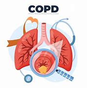 Image result for COPD Pinterest