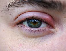 Image result for Stye Symptoms