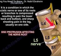 Image result for L3 L4 Sciatica