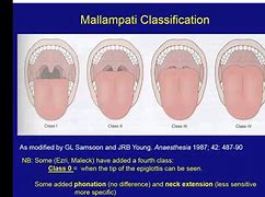 Image result for Narrowing of the Airways