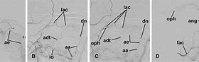 Image result for Dorsal Nasal Artery