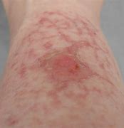 Image result for Spider Rash