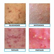 Image result for Infected Acne Pustules