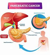 Image result for Pancreatic Cancer