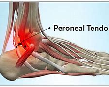 Image result for Peroneal Tendinopathy