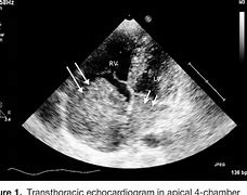 Image result for Cardiac Myxoma