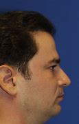 Image result for Mentoplasty