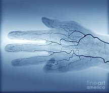 Image result for Hand Angiogram