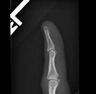 Image result for What Does a Dislocated Pinky Look Like