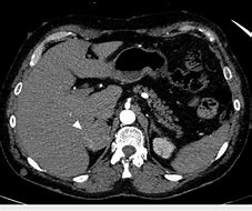 Image result for Pheochromocytoma CT Abdomen