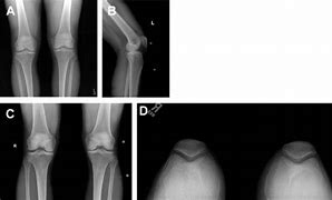 Image result for Meniscal Graft