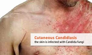 Image result for Candida Skin Rash Symptoms