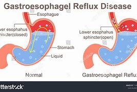 Image result for Esophageal Sphincter Spasm