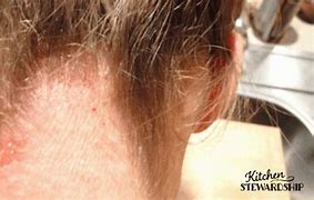 Image result for Candida Neck Rash