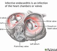 Image result for Acute Endocarditis