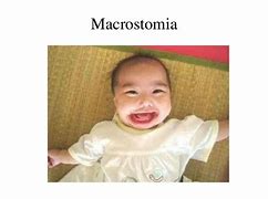 Image result for Microstomia