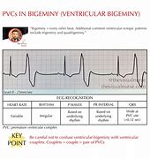 Image result for Bigeminy PVC ECG