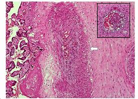 Image result for Organizing Thrombus Histology