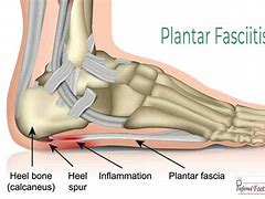 Image result for Heel Pain Plantar Fasciitis Sandals