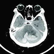 Image result for Orbital Hemorrhage CT