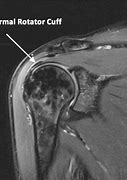 Image result for Shoulder MRI