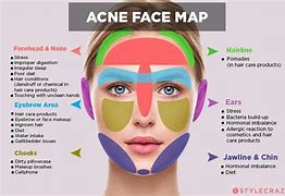 Image result for Acne On Side of Face