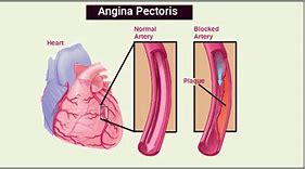 Image result for Angina Pectoris Anatomical Position