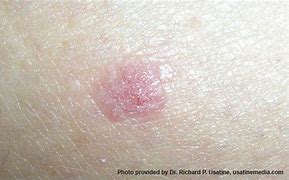 Image result for Bright Pink Mark On Skin