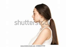 Image result for Acne On Side of Face