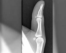 Image result for Avulsion Fracture