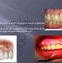 Image result for Col Gingiva