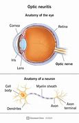 Image result for Enlarged Optic Nerve