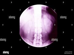 Image result for Kidney On X-ray