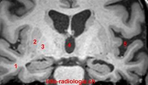 Image result for CT Brain Lentiform Nucleus