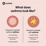 Image result for Symptoms of Asthma