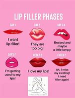 Image result for Hylauronic Pen Lip Filler