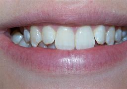 Image result for Fixed Braces Teeth Side View