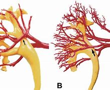 Image result for Retrocaval Artery